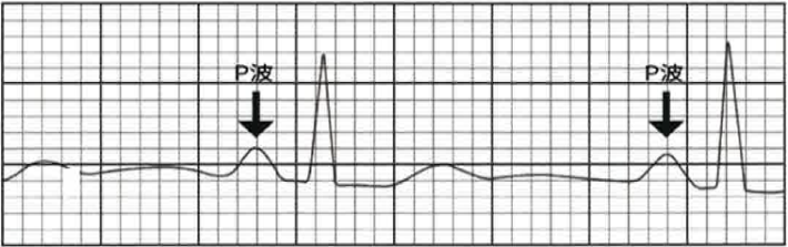 正常P波圖例。代表心律正常。