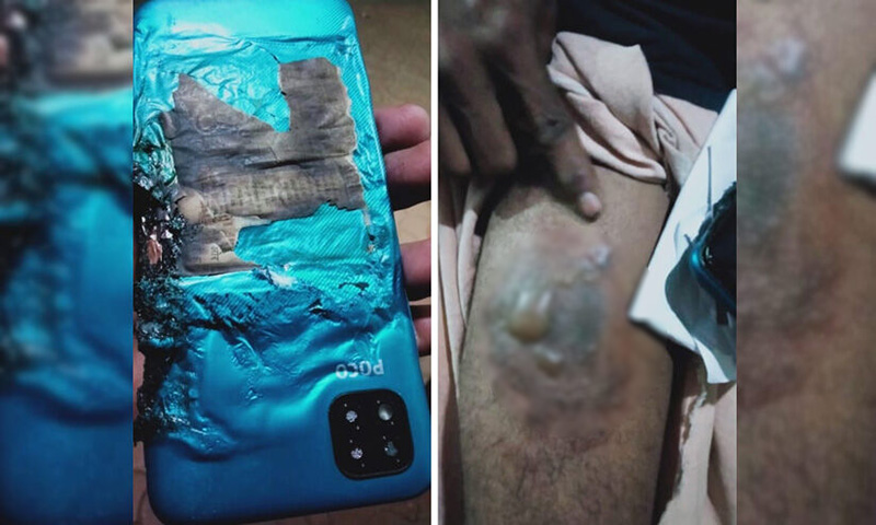 事主褲袋內的 POCO C3 手機突然爆炸起火，從相片可見當事人的大腿有嚴重燒傷的痕跡，而該手機的電池位置嚴重燒焦，外殼亦熔掉了一大部份。（圖片來源：印度madhyamam網站）